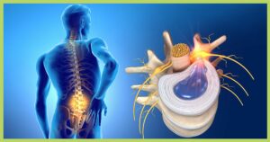 a picture showing a herniated disc